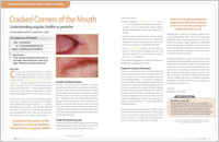 Cracked Corners of the Mouth - Dear Doctor Magazine