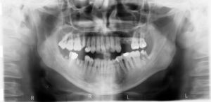 374556_broken_tooth__radiography
