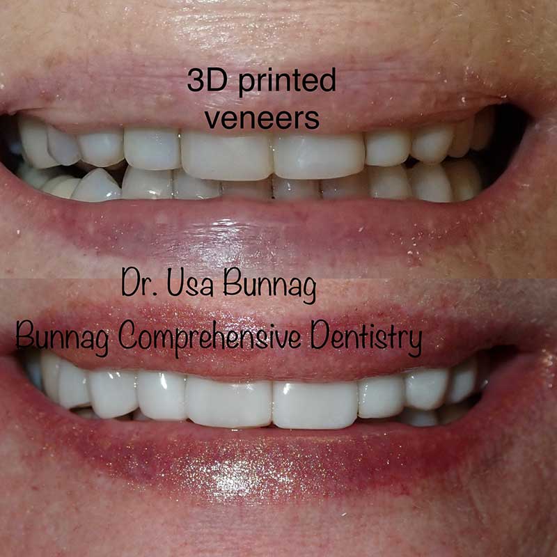 3D Printed Veneers