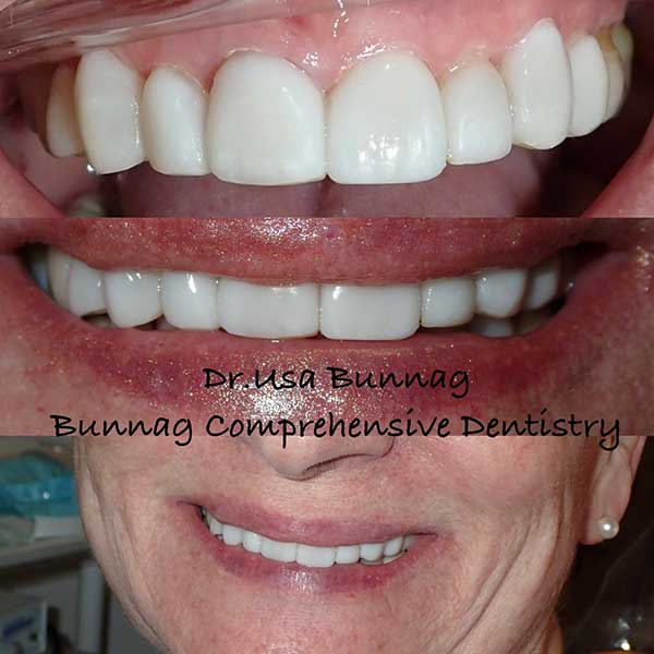 Conservative No-Prep 3D Printed Veneers