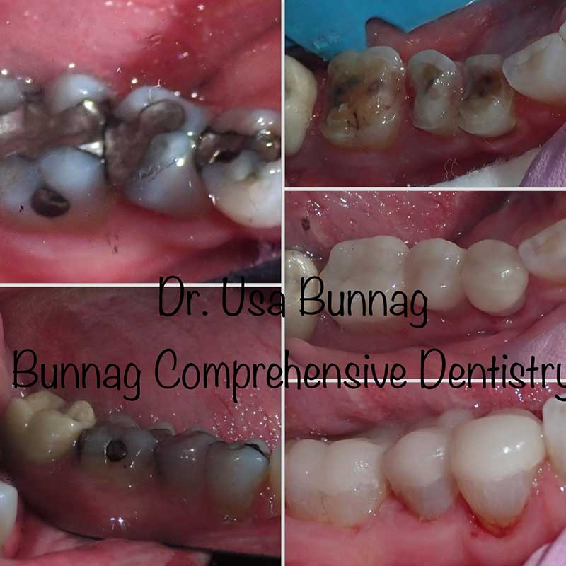 Conservative Same Day Crowns with Cerec